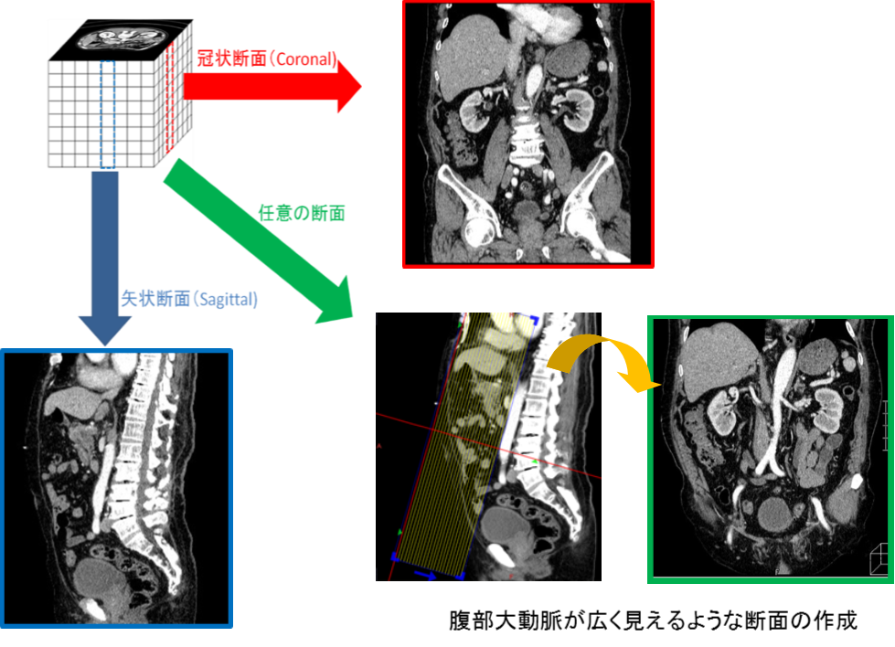 3DCT画像とその成り立ちについて – Radiology@Home