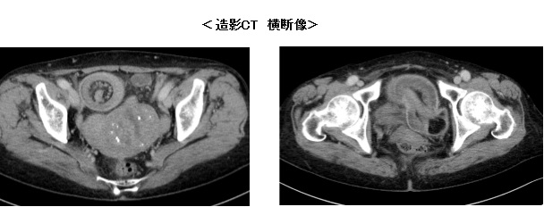 症例(腹部CT)