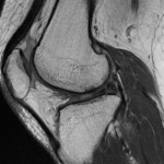 今月の症例（膝MRI）