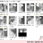 胃がんX線検診における胃前壁撮影 ～精度向上のために～