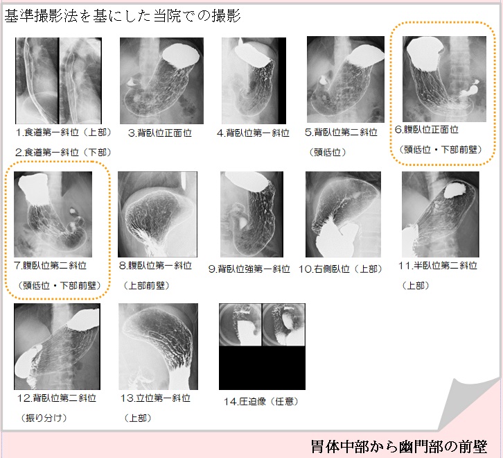 胃がんX線検診における胃前壁撮影 ～精度向上のために～