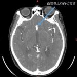 頭部血管CT撮影の実際