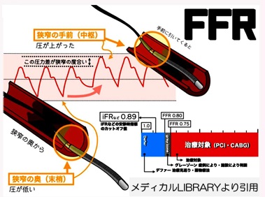 “FFR-Angio”を導入